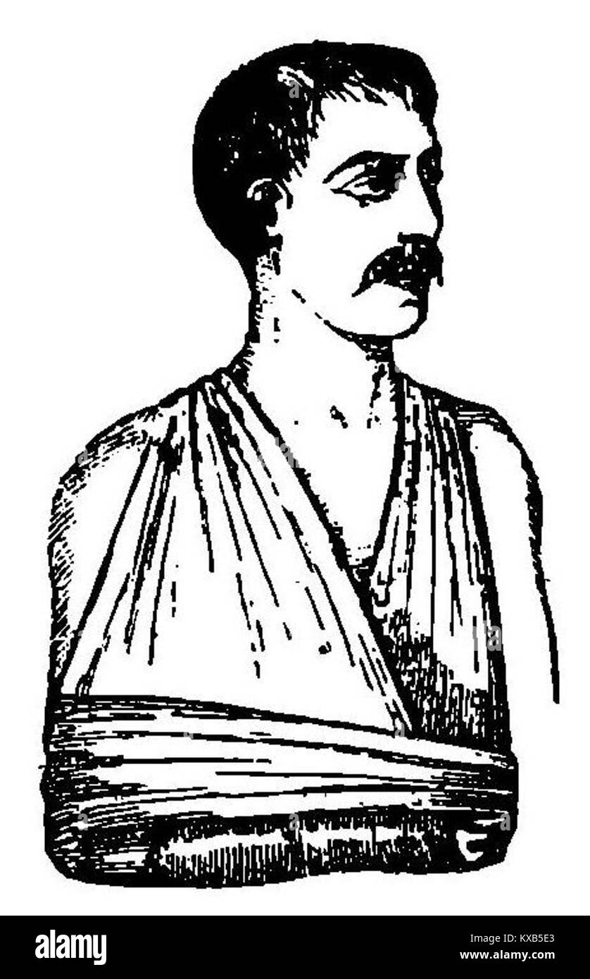 Un'illustrazione medica di Grierson che mostra tecniche di fasciatura per il trattamento delle fratture della clavicola. Foto Stock