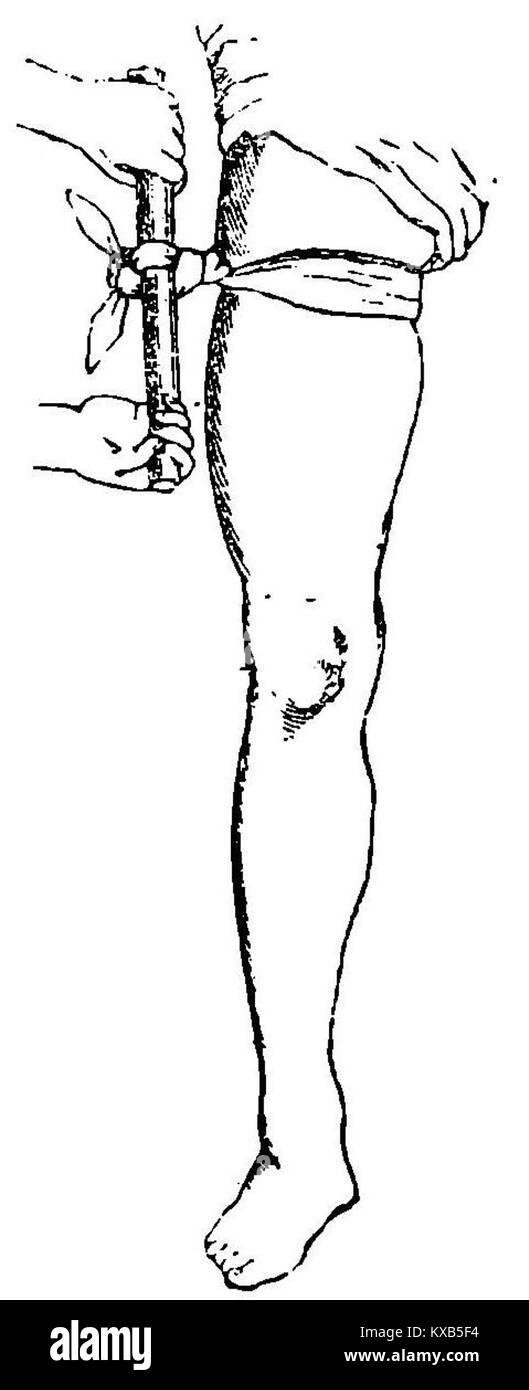 Fotografia che mostra la compressione femorale utilizzando un laccio emostatico, che illustra una procedura medica per controllare l'emorragia in situazioni di emergenza o in condizioni di campo di battaglia. Foto Stock