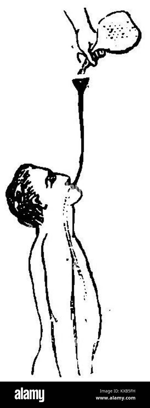 Fotografia che mostra la procedura di lavaggio dello stomaco, che illustra le pratiche mediche all'inizio del XX secolo per la salute gastrointestinale e le tecniche di trattamento. Foto Stock