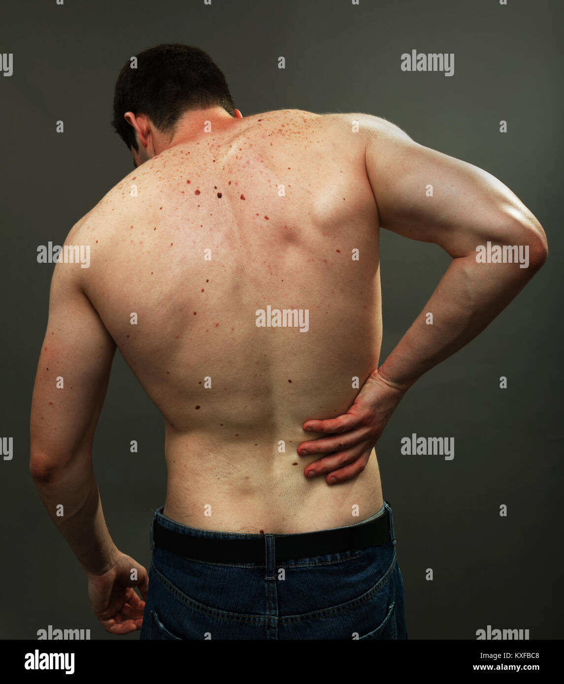 Indietro maschio pelle pieno di moli di melanoma Foto Stock