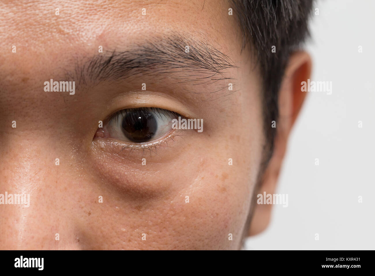 Asian maschile viso pelle grassa con occhio grande borsa con l'occhio sinistro Foto Stock