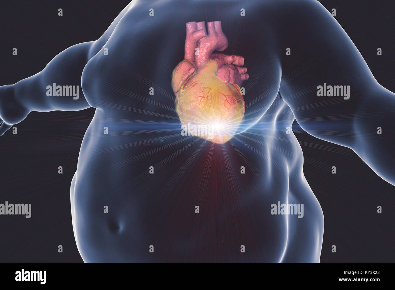 Attacco di cuore nel uomo obesi, illustrazione del computer. Foto Stock