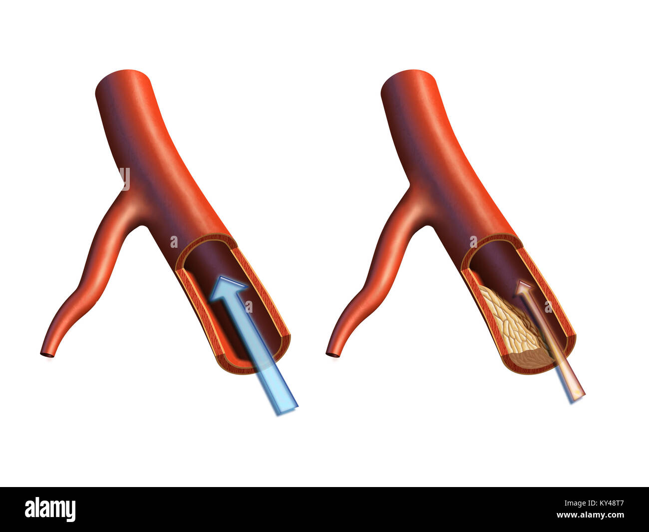 Regolare funzionamento arteria e aterosclerosi formazione della placca. Illustrazione Digitale. Foto Stock