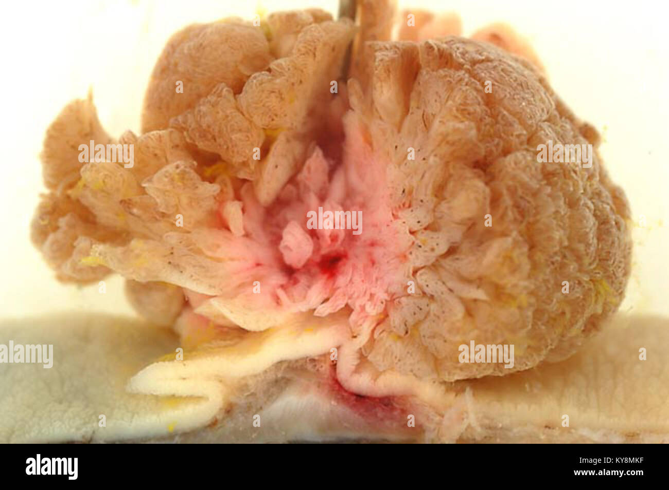 Un esame patologico grossolano di un adenoma villoso nel colon sigmoideo. Gli adenomi villosi sono tumori benigni che possono svilupparsi nel colon e possono progredire verso il cancro del colon. Foto Stock