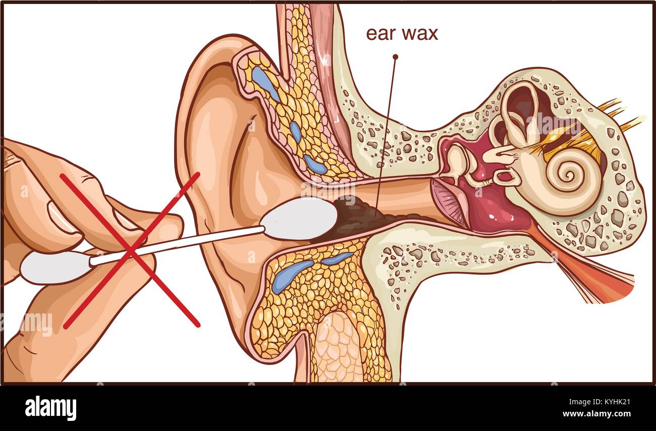 La sezione dell'orecchio con il cerume - schema colorato Illustrazione Vettoriale
