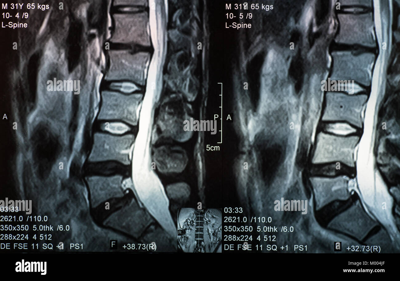 Immagini a risonanza magnetica della colonna vertebrale umana con lordosi, ernia discale e spondylolisthesis l5-s1 Foto Stock