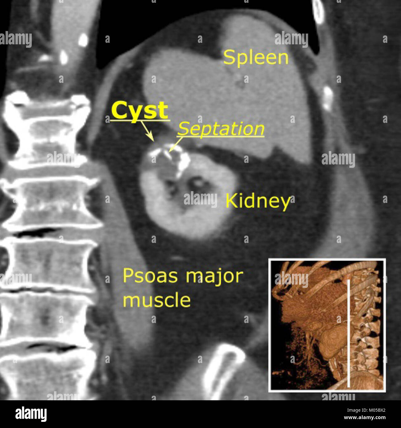 Cisti renale immagini e fotografie stock ad alta risoluzione Alamy Cisti renale immagini e fotografie stock ad alta risoluzione Alamy
