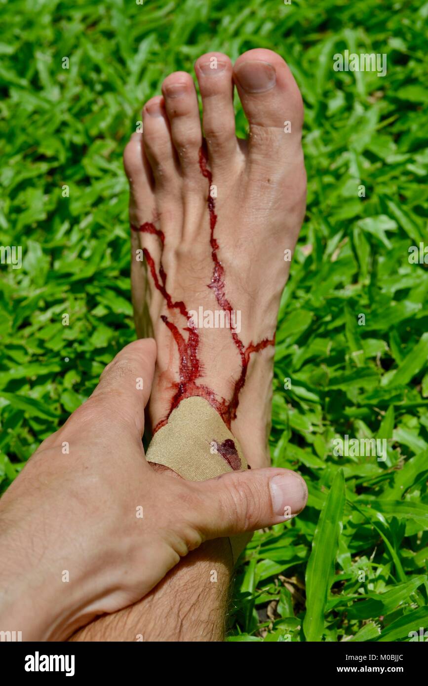 Maschio ferito al piede con sangue reale su un prato verde dello sfondo con il supporto di mano, Townsville, Queensland, Australia Foto Stock