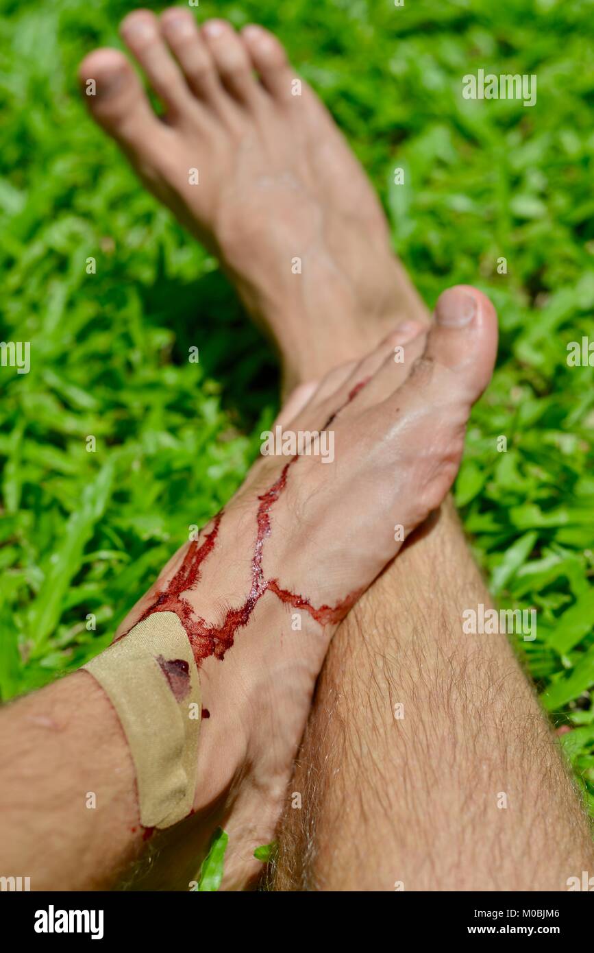 Maschio ferito al piede con sangue reale su un prato verde, sfondo, Townsville Queensland, Australia Foto Stock