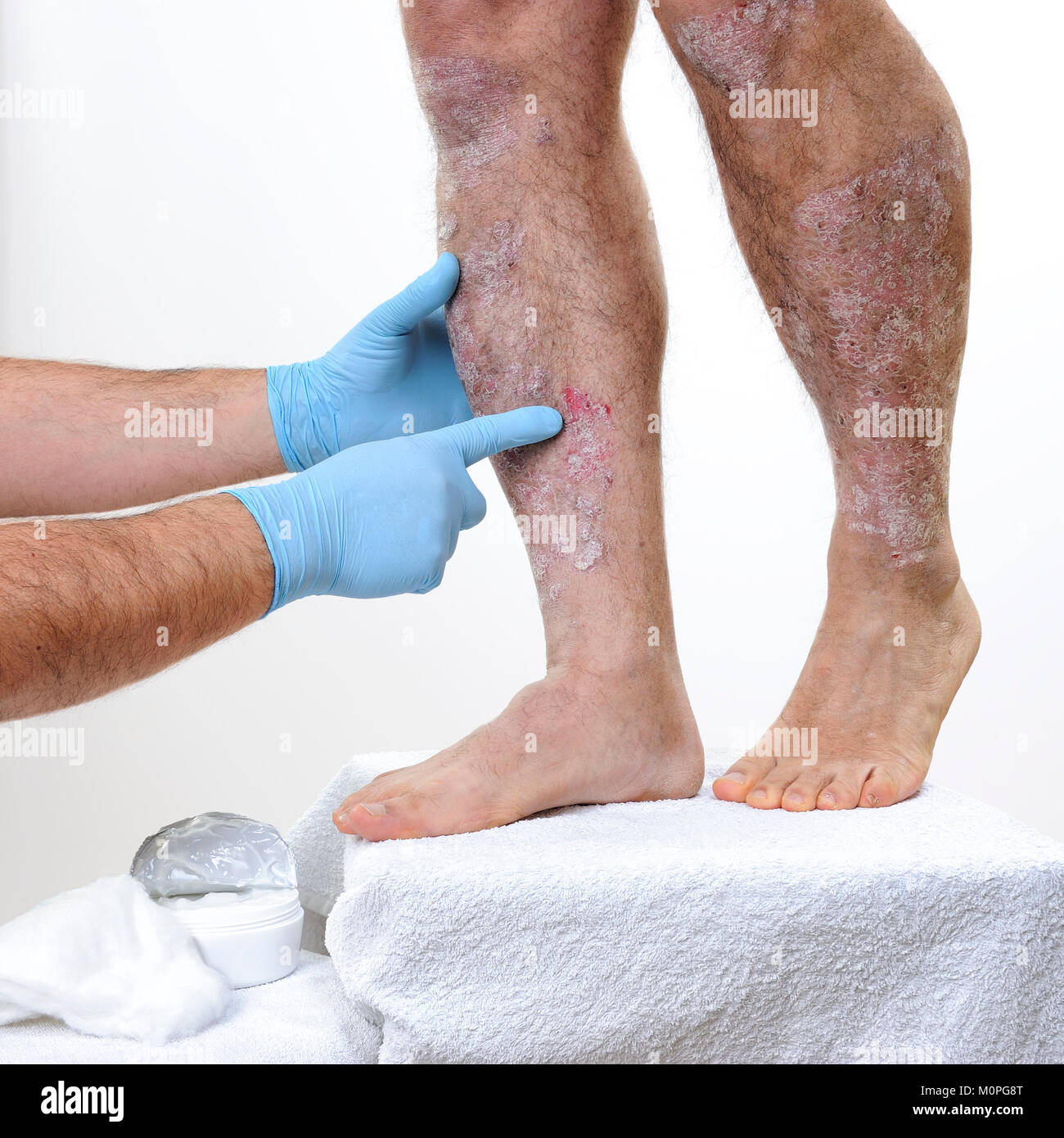 Il dermatologo con le mani protette da guanti studi l infiammazione delle gambe di un uomo adulto con psoriasi Foto Stock