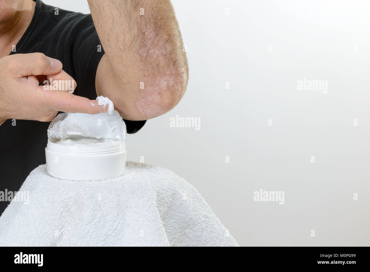 La psoriasi è una malattia infiammatoria cronica della pelle. Dettaglio del  gomito e della crema idratante. Lo spazio vuoto Foto stock - Alamy