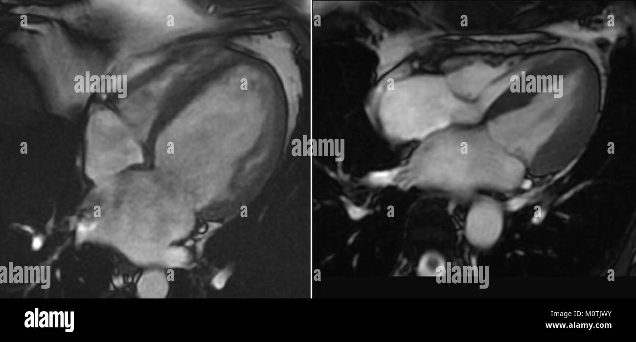 Cardiomr DCM (cardiomiopatia dilatata) è una condizione medica che colpisce il cuore, portando ad una diminuzione della sua capacità di pompare il sangue in modo efficace. Questa condizione può causare sintomi come affaticamento, mancanza di respiro, e ritenzione di liquidi, spesso che richiedono un trattamento medico e monitoraggio. Foto Stock
