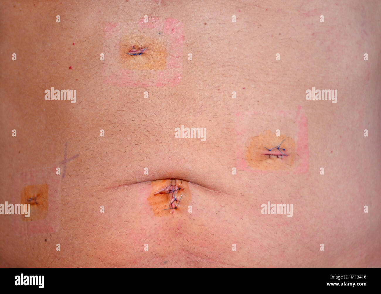 3 Giorno vecchie cicatrici della tecnica laparoscopica Cholocystectomy operazione per rimuovere la cistifellea con sintomatico di calcoli biliari, che mostra 4 incisioni e gonfiato Foto Stock