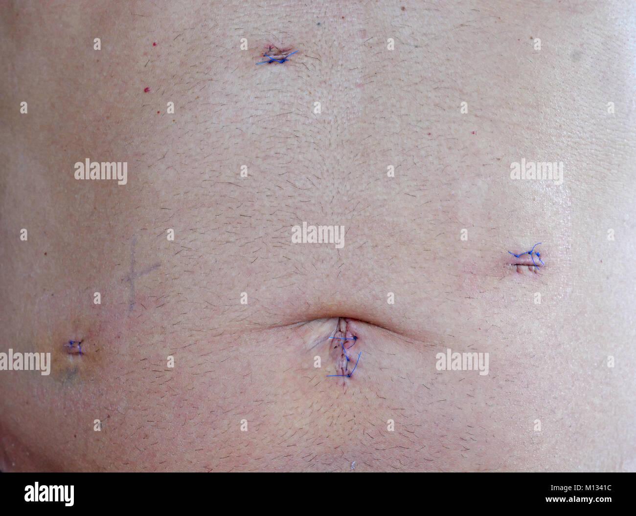 7 Giorno vecchie cicatrici della tecnica laparoscopica Cholocystectomy operazione per rimuovere la cistifellea con sintomatico di calcoli biliari, che mostra 4 incisioni e gonfiato Foto Stock