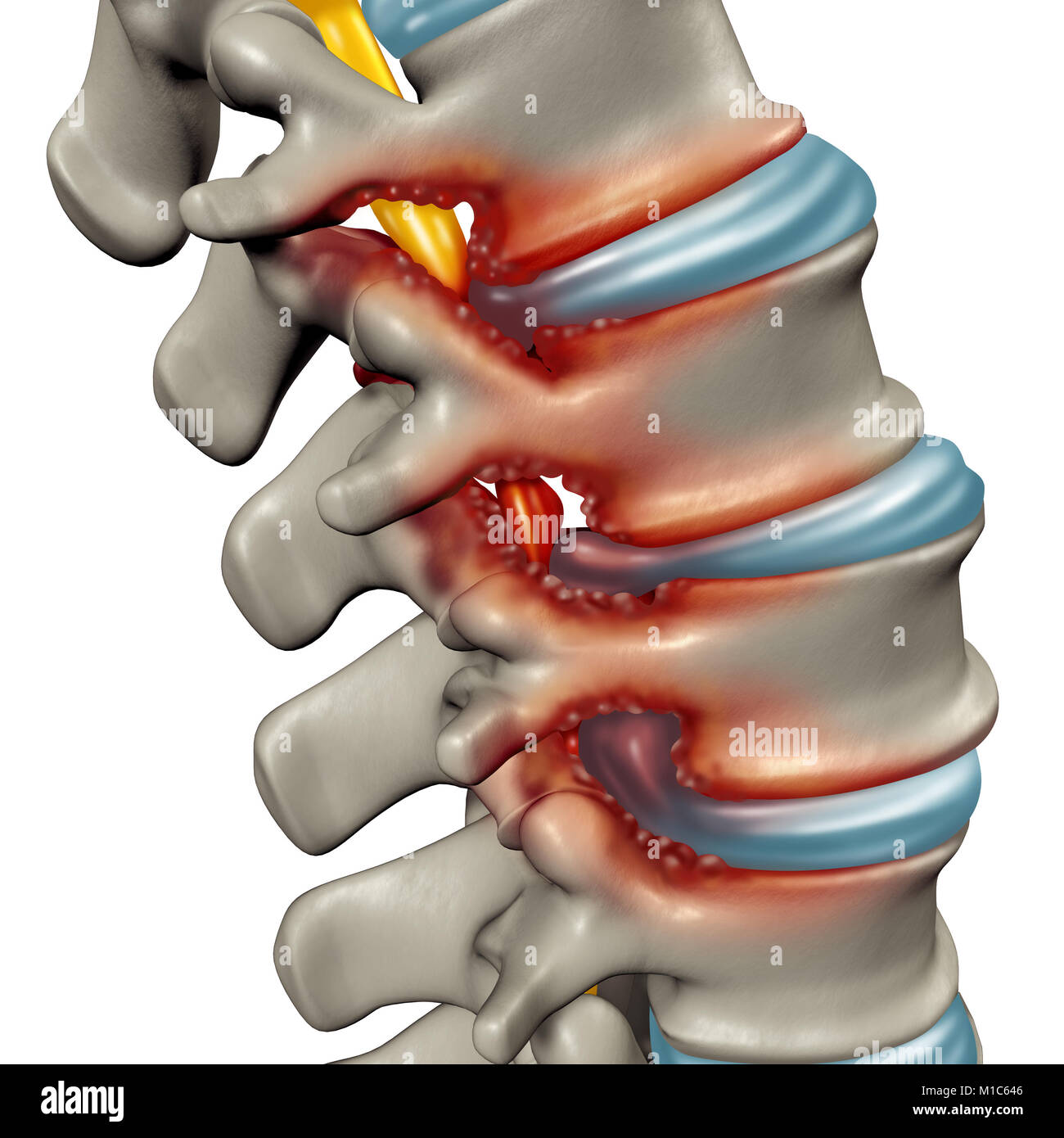 La stenosi spinale come una malattia degenerativa nelle vertebre umane causando la colonna vertebrale compressa nervi concetto medico come 3D'illustrazione. Foto Stock