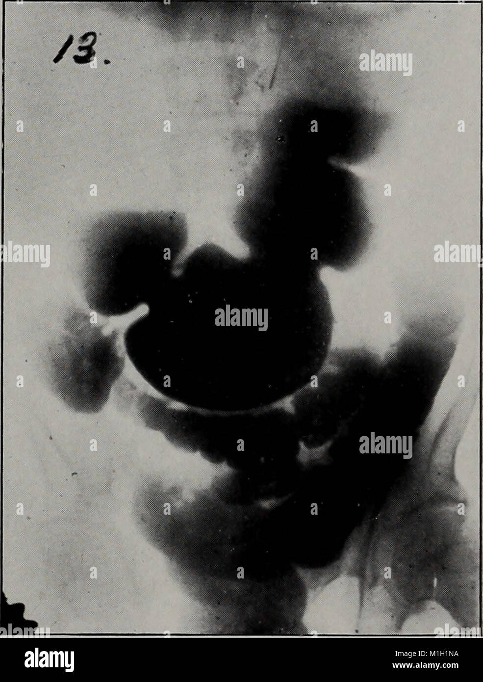 American trimestrale roentgenology (1912) (14754098671) Foto Stock