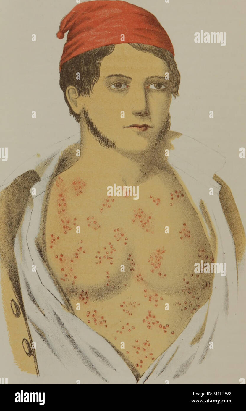 Un trattato di gonorrea e sifilide (1864) (14596906708) Foto Stock