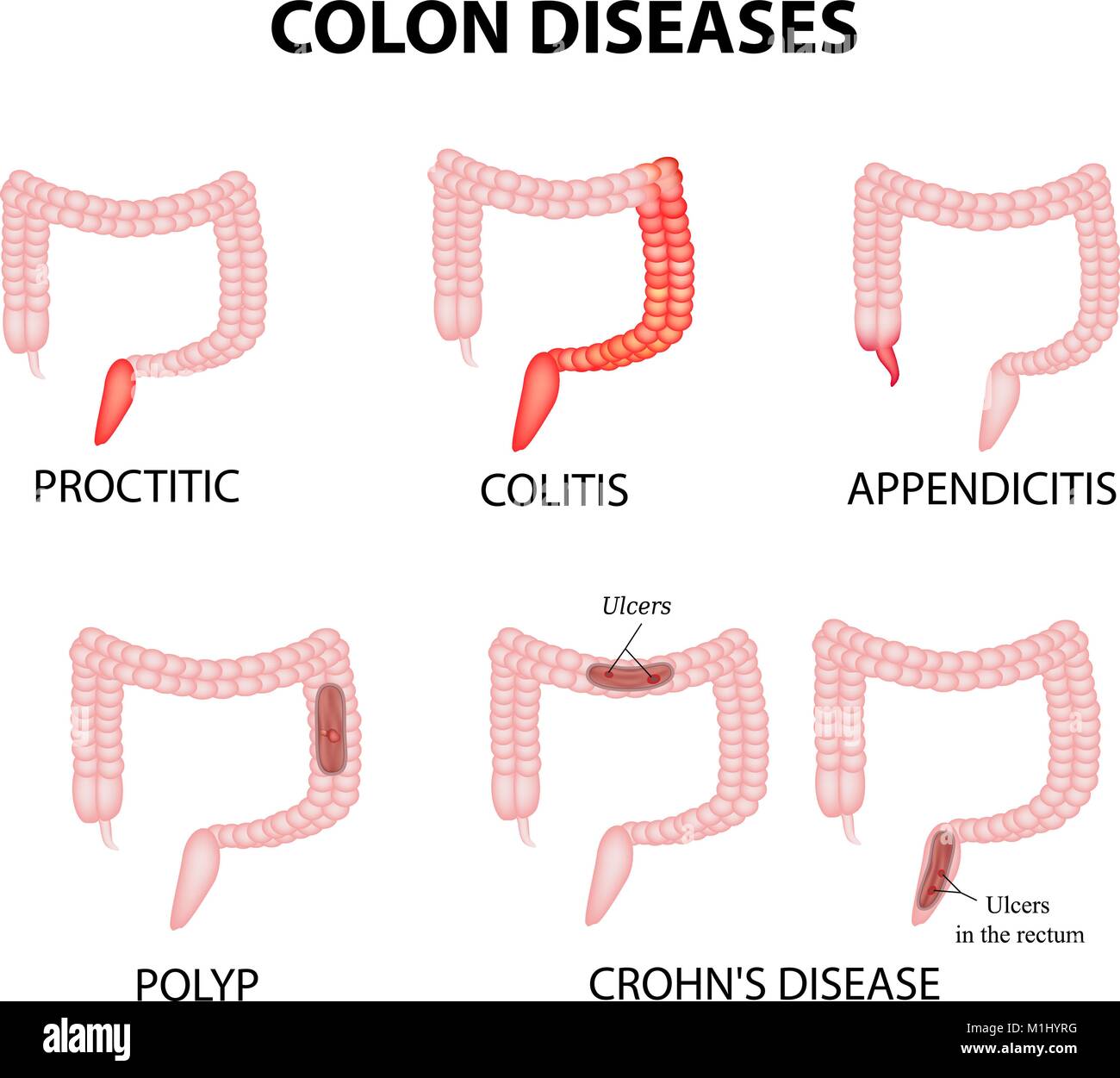 Malattie del colon. , Proctite ulcerosa, appendicite, polipo, ulcera, morbo di Crohn Infographics illustrazione vettoriale su sfondo isolato Illustrazione Vettoriale