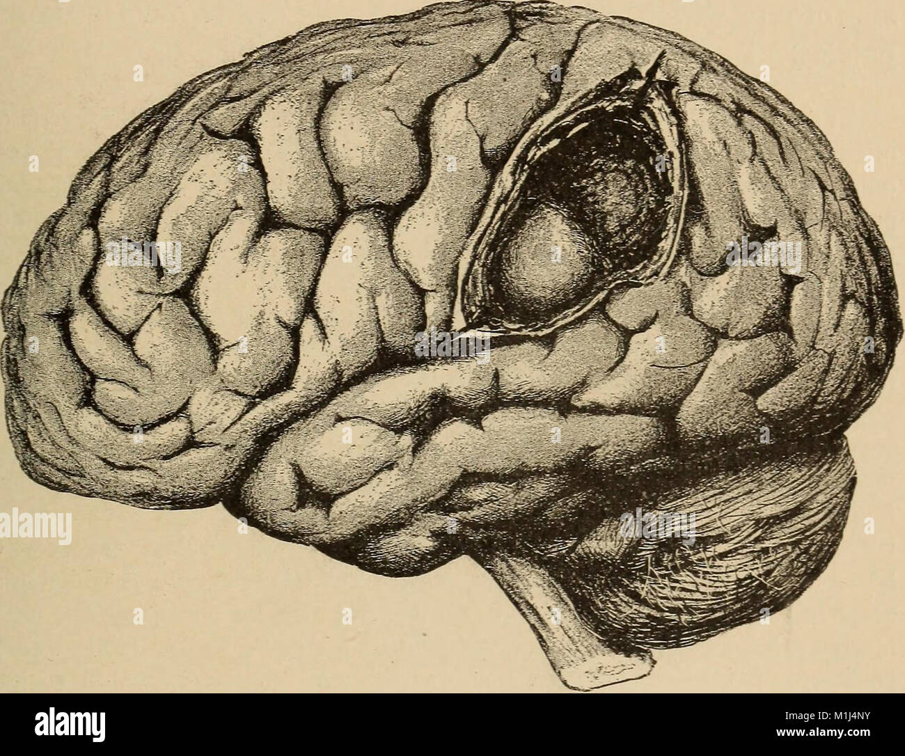 Un trattato sulle malattie del sistema nervoso dei bambini, per i medici e gli studenti (1905) (14782324284) Foto Stock
