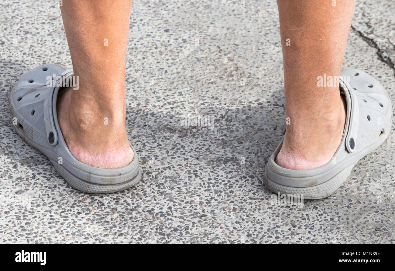 Crocs sandali. Persona che indossa Crocs senza calze. Le lacerazioni della pelle sul tallone Foto Stock