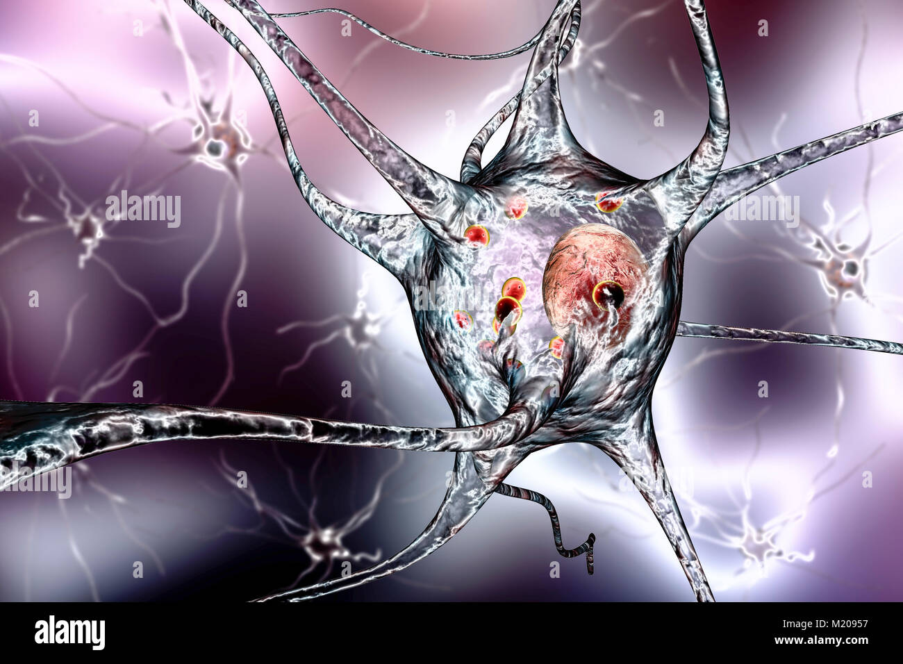 Il morbo di Parkinson cellule nervose. Illustrazione del calcolatore di umana le cellule nervose interessate da corpi di Lewy (piccole sfere di colore rosso all'interno del citoplasma di neuroni) nel cervello di un paziente con malattia di Parkinson. I corpi di Lewy sono accumuli anormali di proteine che si sviluppano all'interno di cellule nervose nel morbo di Parkinson, la demenza di Lewy Body, e di alcuni altri disturbi neurologici. Foto Stock