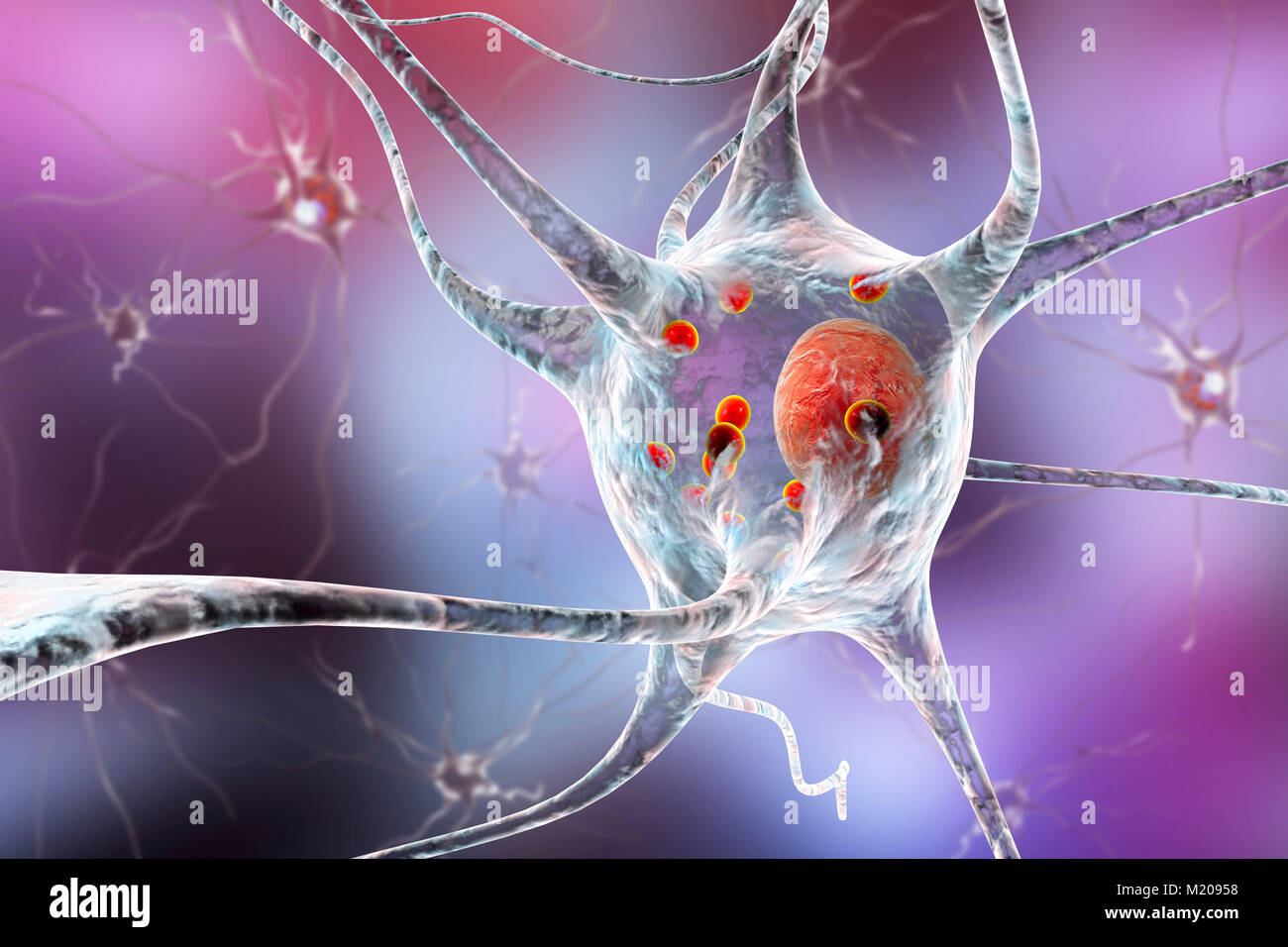 Il morbo di Parkinson cellule nervose. Illustrazione del calcolatore di umana le cellule nervose interessate da corpi di Lewy (piccole sfere di colore rosso all'interno del citoplasma di neuroni) nel cervello di un paziente con malattia di Parkinson. I corpi di Lewy sono accumuli anormali di proteine che si sviluppano all'interno di cellule nervose nel morbo di Parkinson, la demenza di Lewy Body, e di alcuni altri disturbi neurologici. Foto Stock