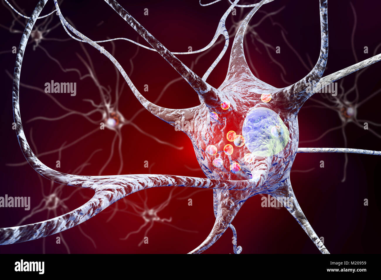 Il morbo di Parkinson cellule nervose. Illustrazione del calcolatore di umana le cellule nervose interessate da corpi di Lewy (piccole sfere di colore rosso all'interno del citoplasma di neuroni) nel cervello di un paziente con malattia di Parkinson. I corpi di Lewy sono accumuli anormali di proteine che si sviluppano all'interno di cellule nervose nel morbo di Parkinson, la demenza di Lewy Body, e di alcuni altri disturbi neurologici. Foto Stock