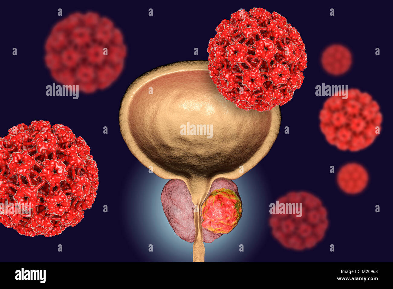 Eziologia virale del cancro della prostata. Illustrazione concettuale che illustra i papillomavirus umani (HPV) di infettare ghiandola della prostata e provocando lo sviluppo del cancro. Foto Stock