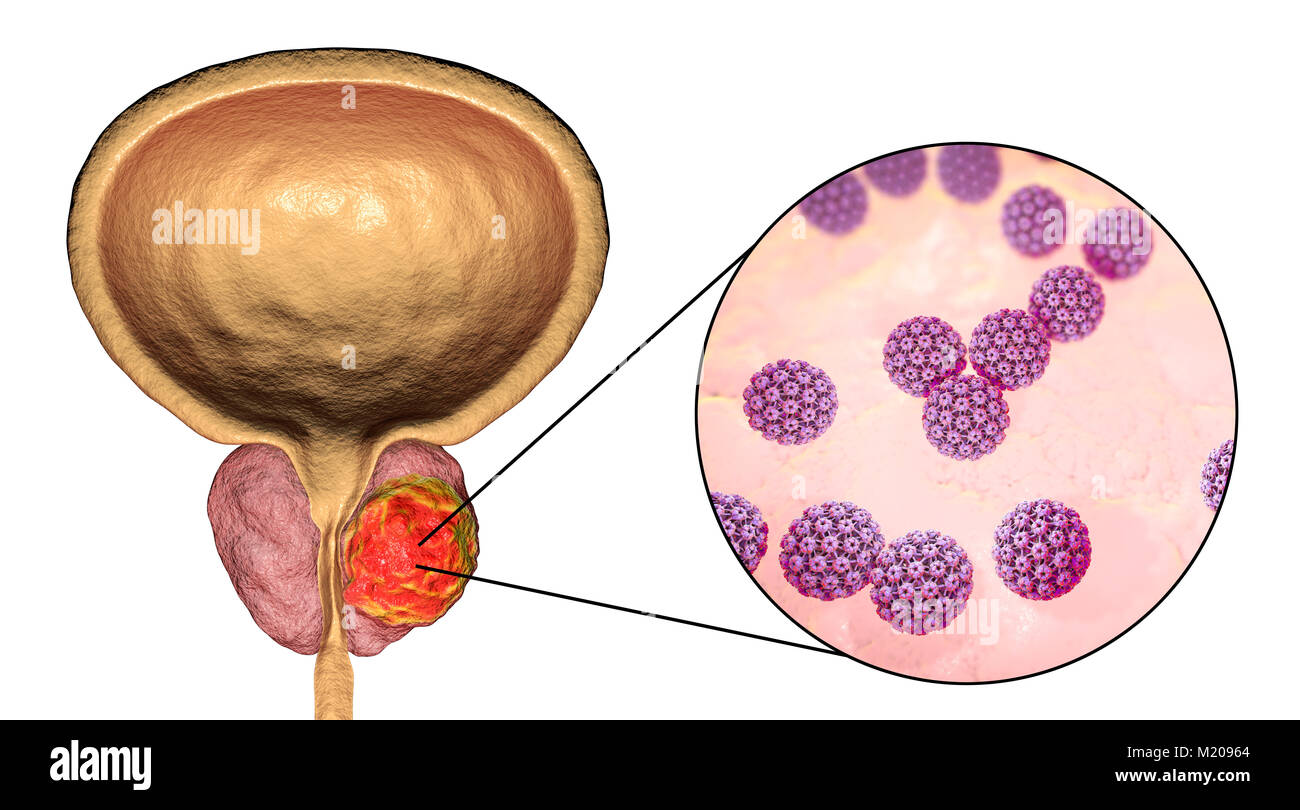 Eziologia virale del cancro della prostata. Illustrazione concettuale che illustra i papillomavirus umani (HPV) di infettare ghiandola della prostata e provocando lo sviluppo del cancro. Foto Stock