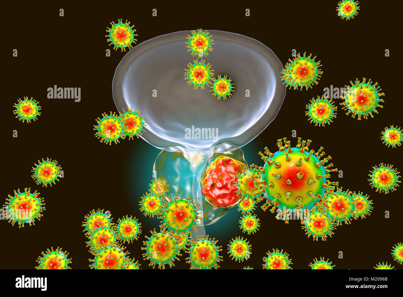 Eziologia virale del cancro della prostata. Illustrazione concettuale che illustra i virus di infettare ghiandola della prostata e provocando lo sviluppo del cancro. Foto Stock