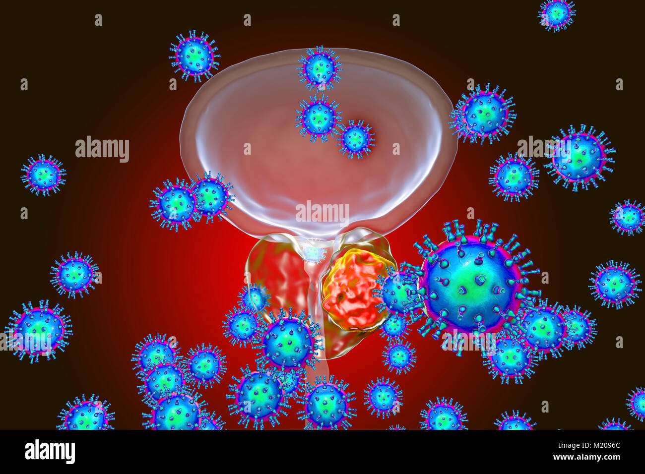 Eziologia virale del cancro della prostata. Illustrazione concettuale che illustra i virus di infettare ghiandola della prostata e provocando lo sviluppo del cancro. Foto Stock