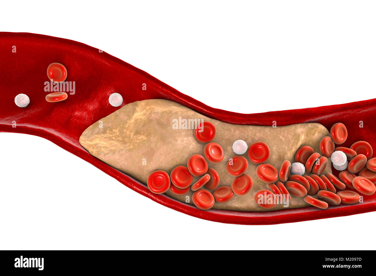 Placche ateromatose all'interno del vaso sanguigno, illustrazione del computer. Un colesterolo ateroma sta causando un restringimento di una arteria (aterosclerosi). Foto Stock