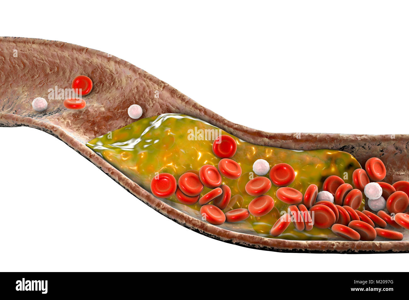 Placche ateromatose all'interno del vaso sanguigno, illustrazione del computer. Un colesterolo ateroma sta causando un restringimento di una arteria (aterosclerosi). Foto Stock