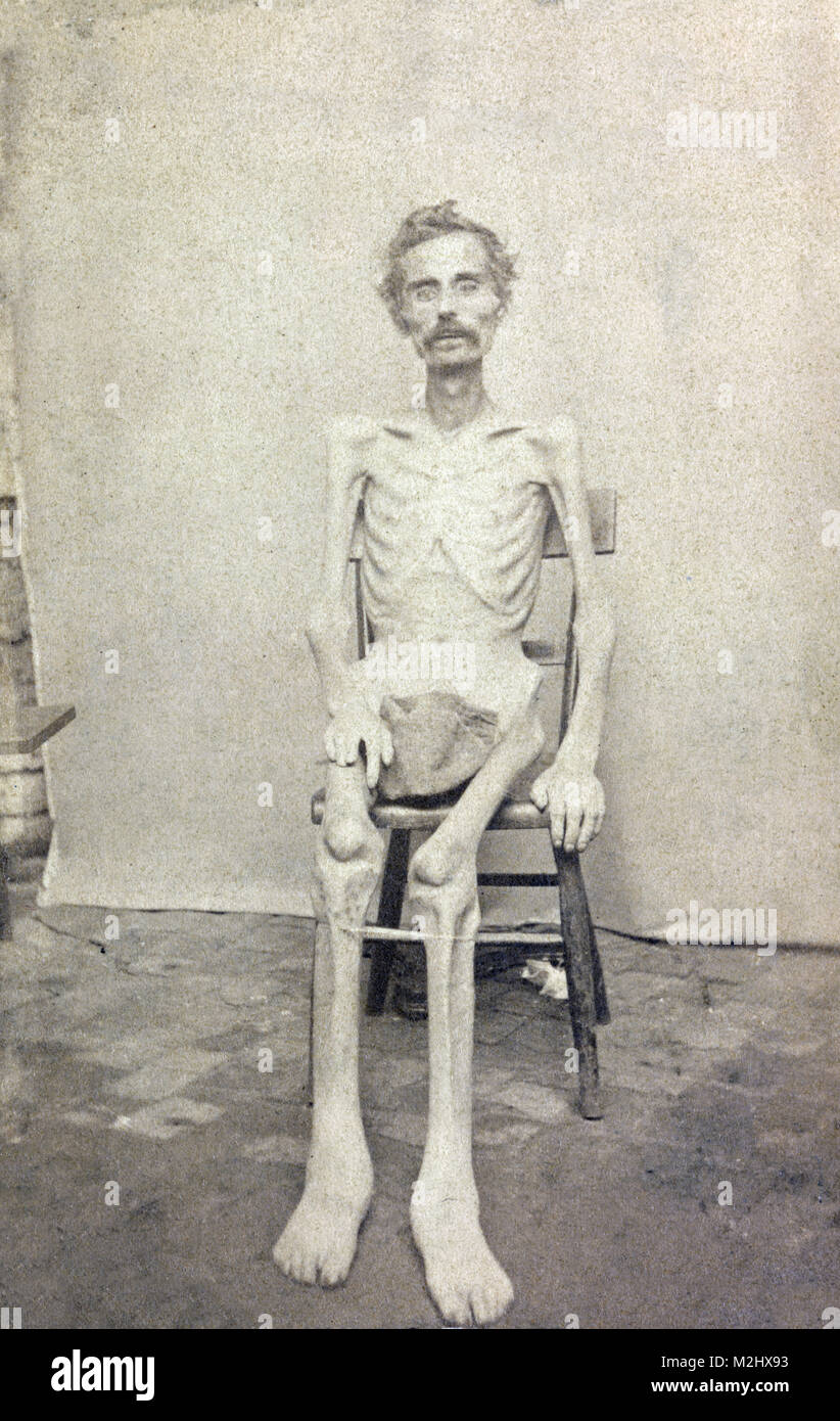 La guerra civile americana, emaciata Unione POW, 1865 Foto Stock