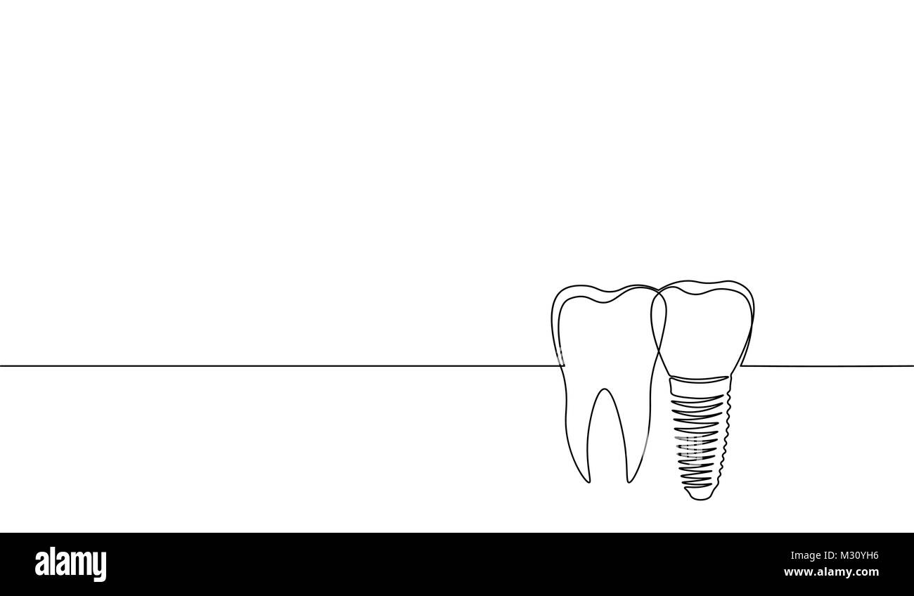 Singola linea continua arte anatomica dente umano silhouette impianto. Medicina sani di recupero radice molare cavità concept design mondo salute orale giorno uno schizzo schizzo illustrazione vettoriale Illustrazione Vettoriale