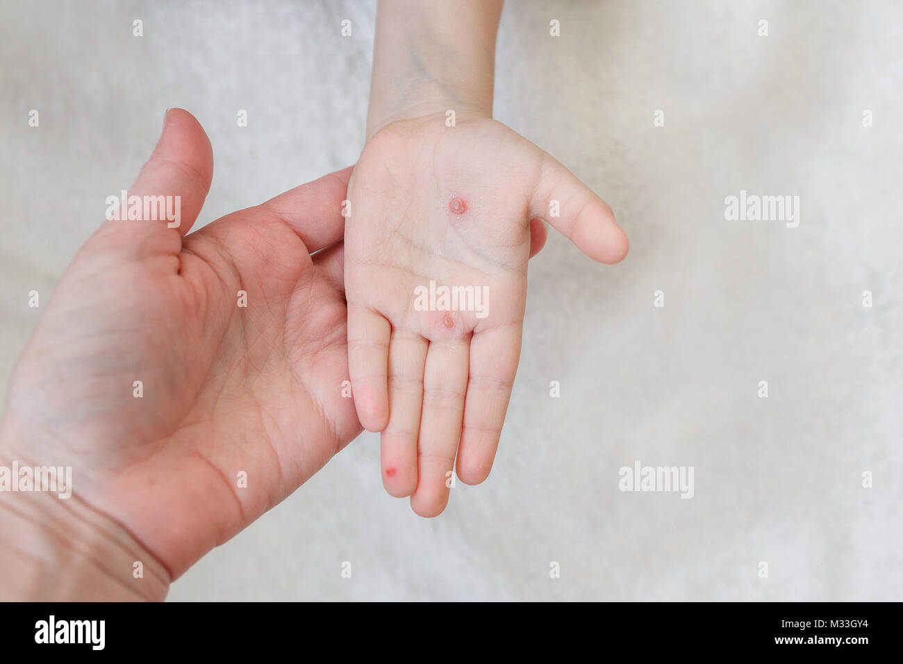 La mano di un bambino con la varicella in sua madre la mano. Le vesciche sulla mano da varicella Foto Stock