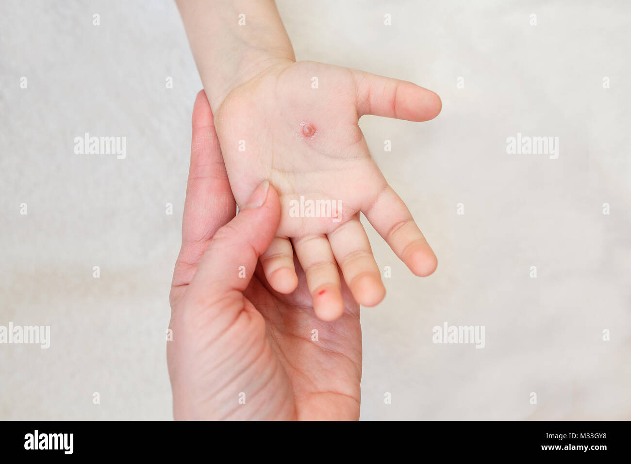 La mano di un bambino con la varicella in sua madre la mano. Le vesciche sulla mano da varicella Foto Stock