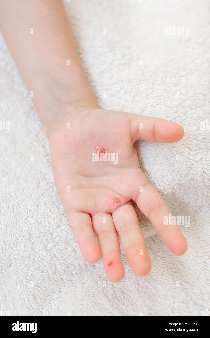 La mano di un bambino con la varicella. Le vesciche sulla mano da varicella Foto Stock