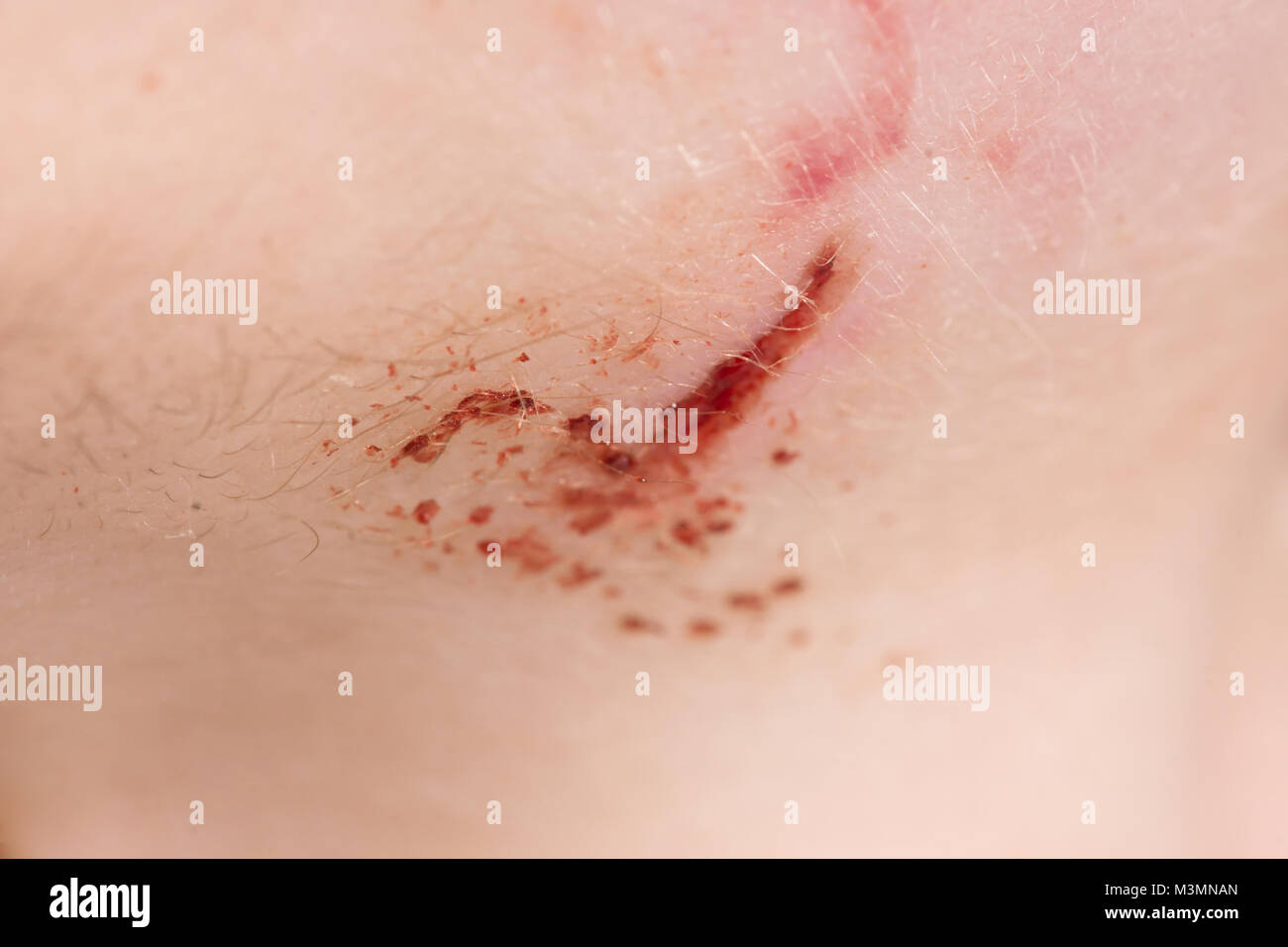 Il sanguinamento fresco avvolto su una persona pelle closeup Foto Stock