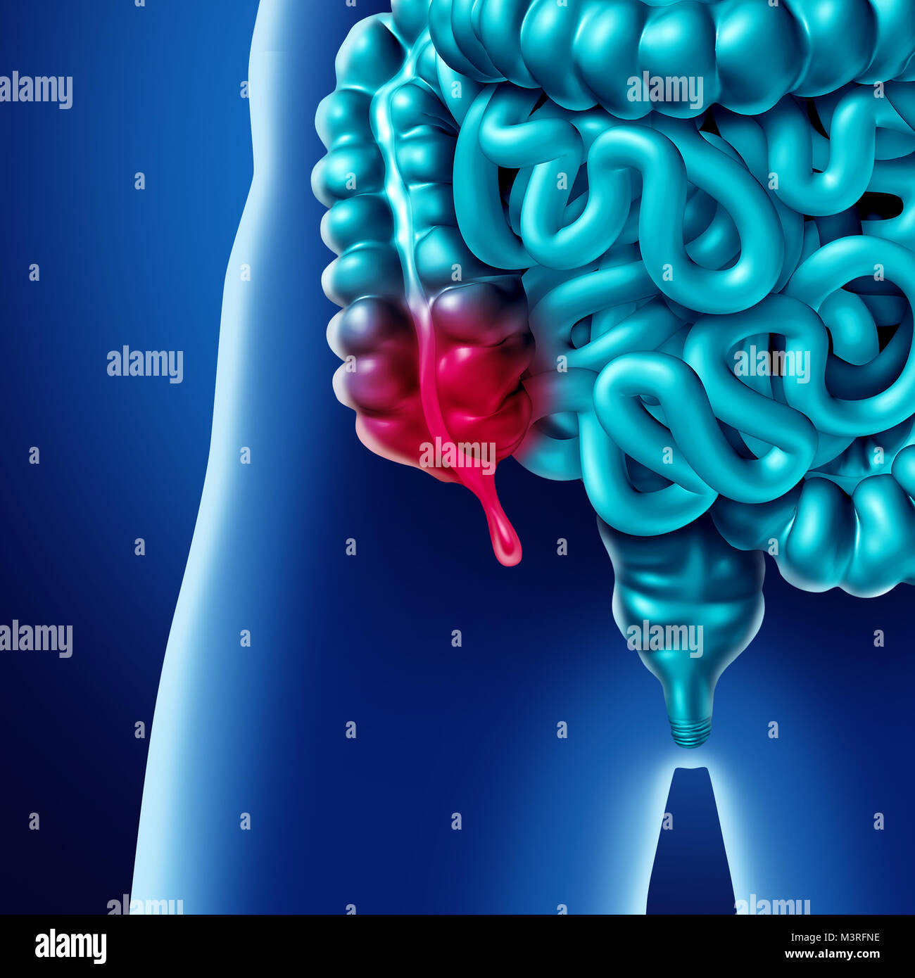Appendice dolore e infiammazione appendicite concetto di malattia come una chiusura di intestino umano anatomia come 3D'illustrazione. Foto Stock