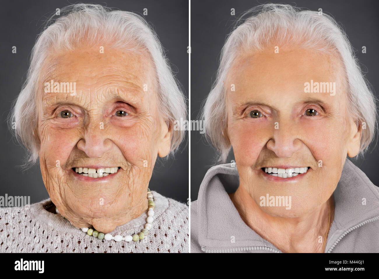 Senior donna anti invecchiamento della pelle trattamento prima e dopo Foto Stock