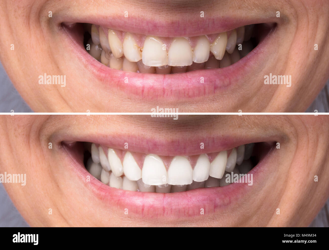 Close-up dettaglio della persona che mostra i denti prima e dopo sbiancamento Foto Stock