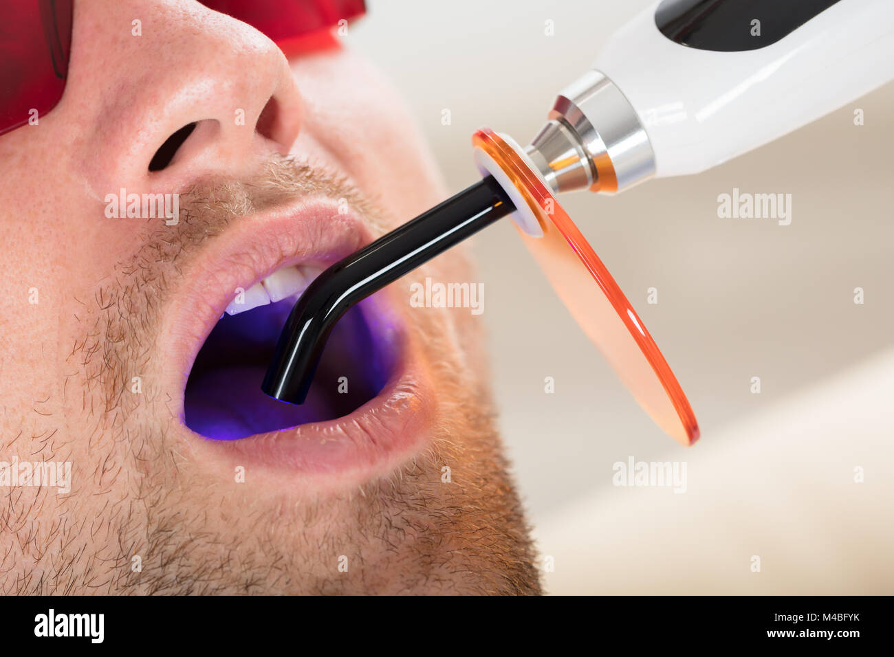 Uomo di denti sono trattati con Dental indurimento UV lampada luce Foto Stock