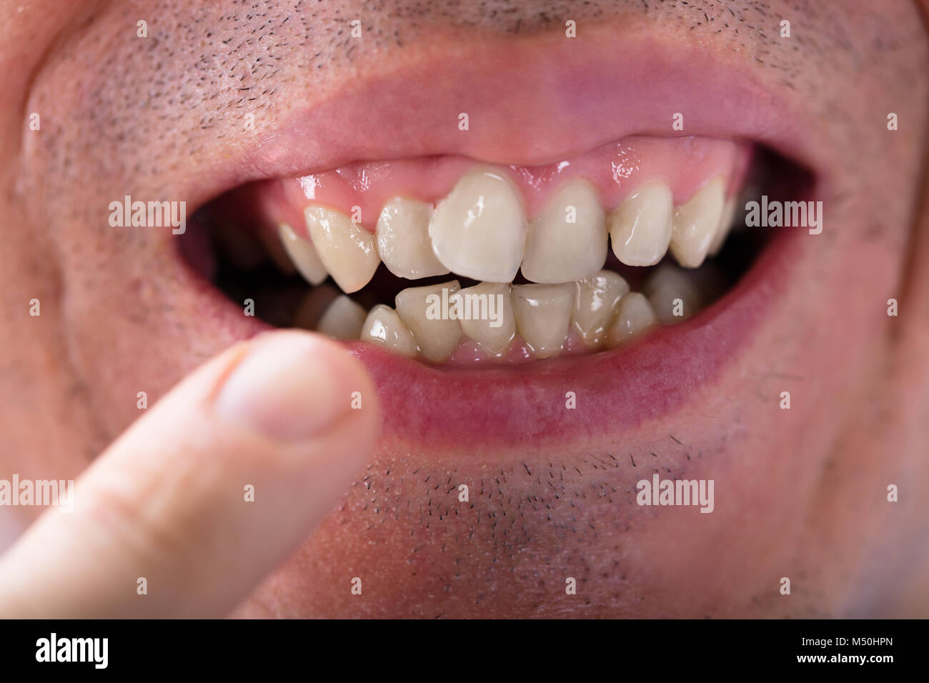 Close-up di un uomo che mostra i suoi denti Foto Stock