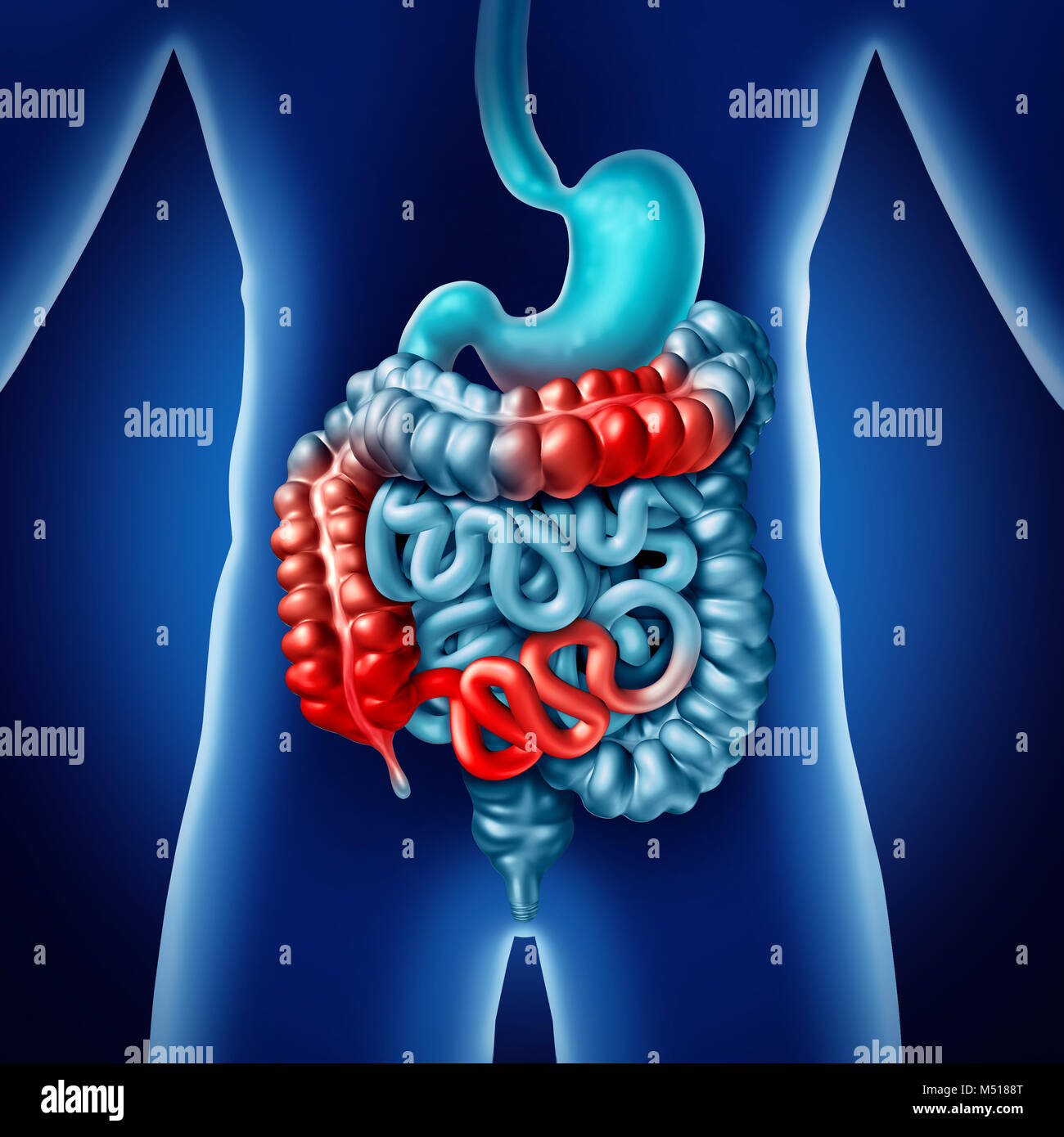 Morbo di Crohn e intestino o malattia di crohns concetto medico come digestivo umano del colon con sintomi di infiammazione causando ostruzioni. Foto Stock