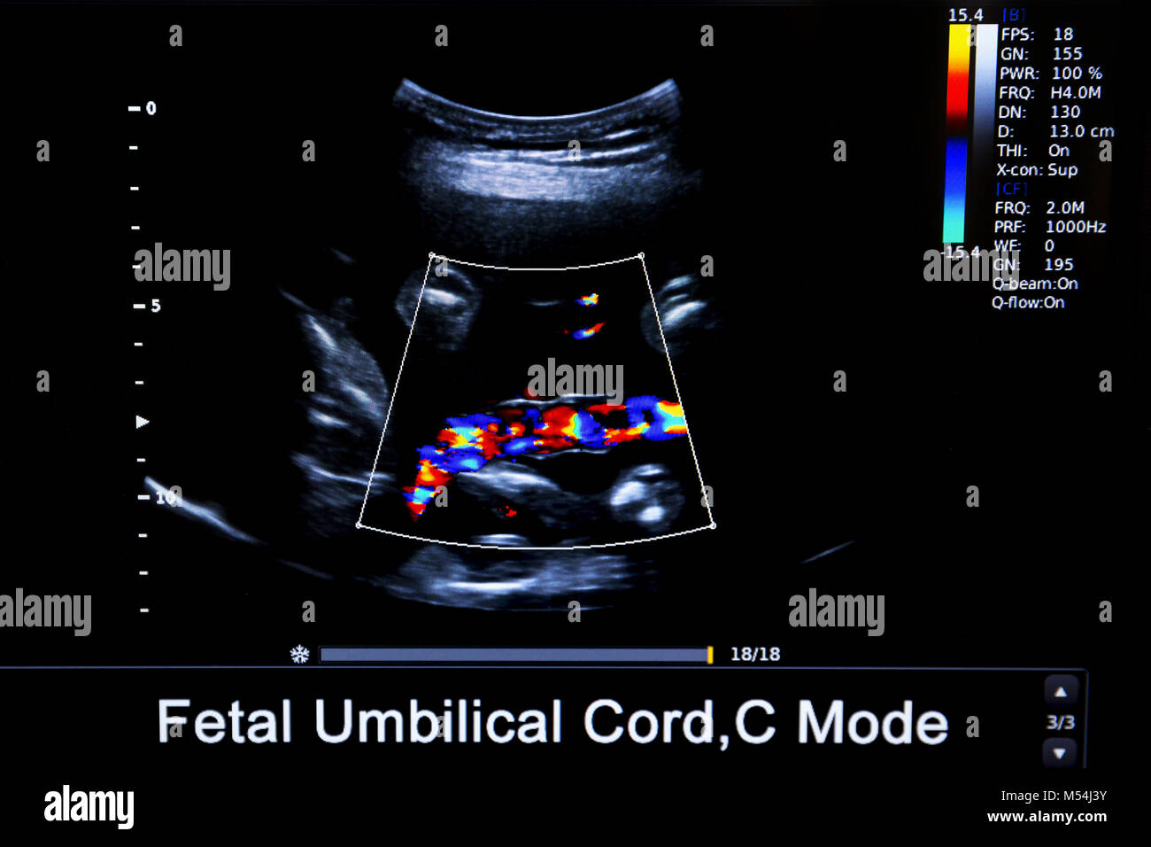Immagine colorata di gravidanza monitor ad ultrasuoni Foto Stock