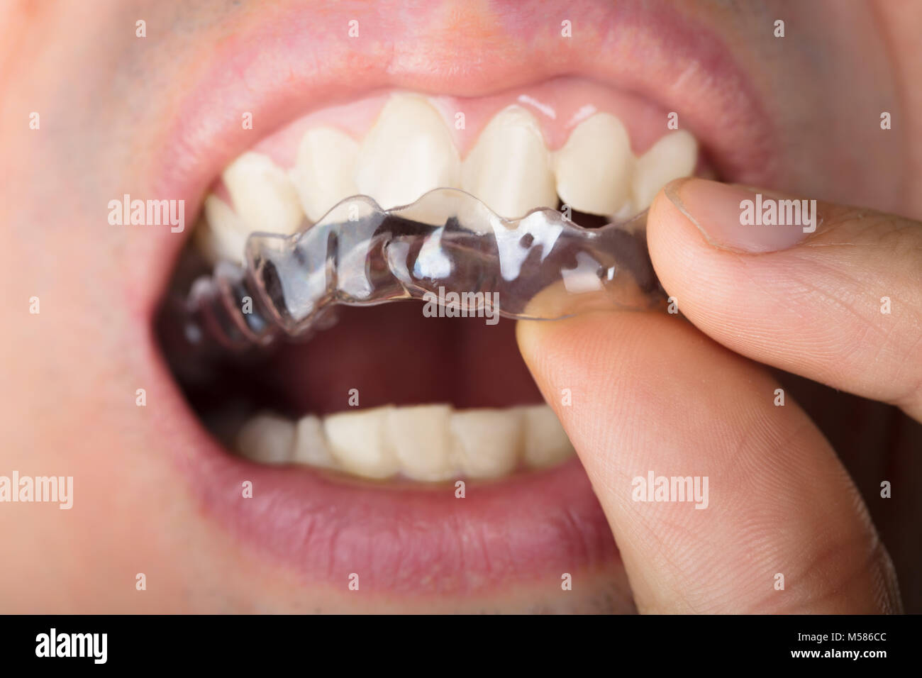 Immagine ritagliata dell uomo di regolazione di allineatori trasparenti in denti Foto Stock