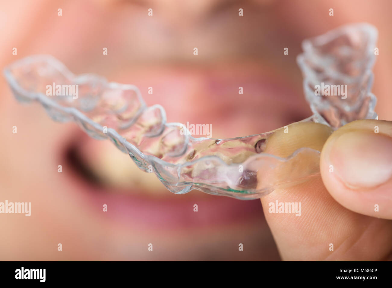 Immagine ritagliata dell'uomo azienda trasparente allineatori di denti Foto Stock