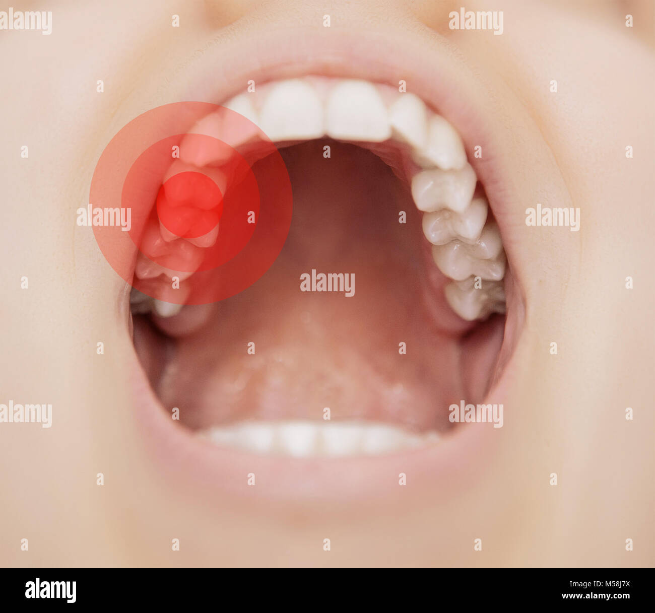 Tootache, aprire bocca con dolore, toothcare Foto Stock