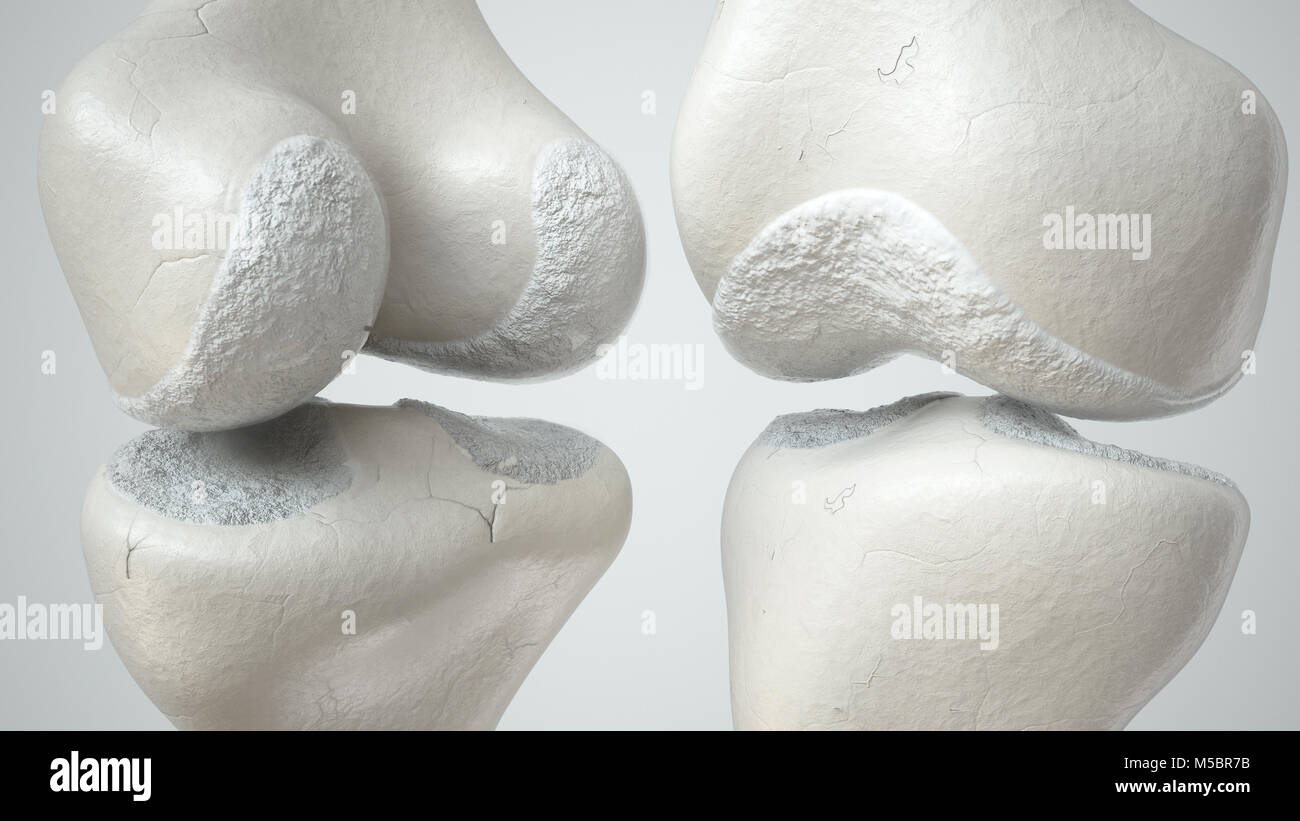 Articolazione del Ginocchio con perdita di cartilagine a causa Arthose, fronte e retro- 3D Rendering Foto Stock
